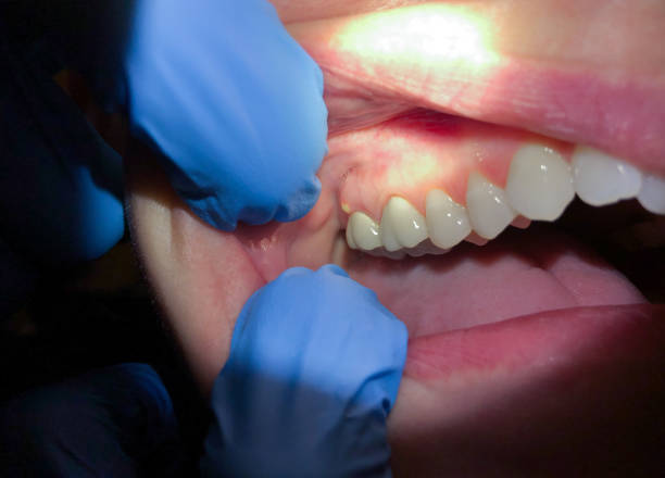 Best Emergency Wisdom Teeth Removal in Haynesville, LA
